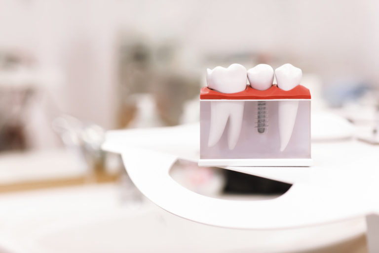 dentist dental teeth teaching model showing titanium metal tooth implant screw